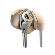 Замена колена код артритиса